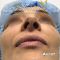 Rhinoplastie