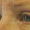 Operácia očných viečok (Blepharoplastika)