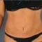CoolSculpting
