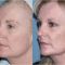 PRP – Plazma terapie (Platelet Rich Plasma)
