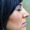 Operácia nosa (Rhinoplastika)