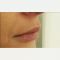 Lip augmentation - cheiloplasty