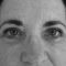 Blépharoplastie