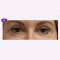Operácia očných viečok (Blepharoplastika)
