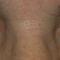 Eyelid surgery (Blepharoplasty)