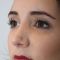 Rhinoplastie Ultrasonique