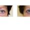 Eyelid surgery (Blepharoplasty)