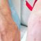 Kwas hialuronowy: Saypha, Restylane, Juvederm, Stylage