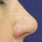 Rinoplastika (operacija nosa)