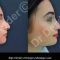 Rhinoplastie secondaire
