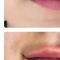 Kwas hialuronowy: Saypha, Restylane, Juvederm, Stylage