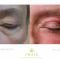 Operácia očných viečok (Blepharoplastika)