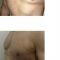 Lipofilling al seno