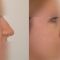 Rhinoplasty (Nose Job)