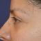 Eye Bags Treatment