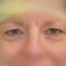 Eyelid surgery (Blepharoplasty)