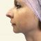 Lipofilling, Lipografting, Lipotransfer (přenos a aplikace vlastního tuku)