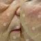 Filler antirughe a base di acido ialuronico