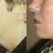 Lifting du visage