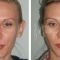 Ear surgery (Otoplasty)