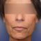 Facelift (operace obličeje), SMAS lifting