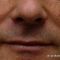 Lip Lift