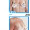 Lipofilling al seno