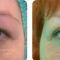 Operácia očných viečok (Blepharoplastika)