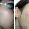 Traitements laser - dermatologie esthétique