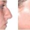 Rhinoplastie
