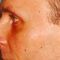 Plastika nosu (Rhinoplastika)