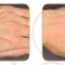 PRP – Plazma terapia (Drakula terapia)