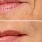 Filler antirughe a base di acido ialuronico