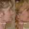 Facelift, SMAS Facelift