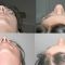 Rhinoplastie