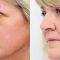 Eyelid surgery (Blepharoplasty)