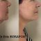 Lifting du visage
