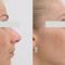 Plastika nosu (Rhinoplastika)