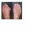 Bunion surgery (hallux valgus)