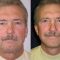 Facelift, SMAS facelifting