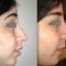 Rhinoplastie médicale