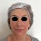 Dermal fillers