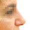 Operácia nosa (Rhinoplastika)