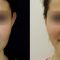 Ear surgery (Otoplasty)