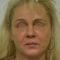 Facelift, SMAS Facelift