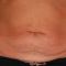 Abdominoplastyka (operacja powłok brzucha)