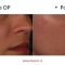 Mole removal