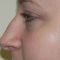 Rhinoplasty (Nose Job)