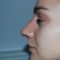 Rinoplastika (operacija nosa)