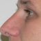 Nasenkorrektur - Rhinoplastik